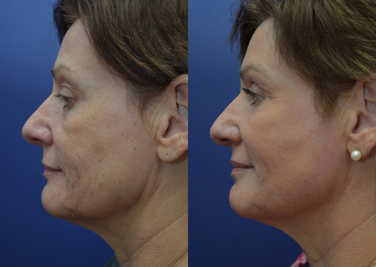 Non-Surgical Soft Tissue Fillers Before & After Gallery - Patient 340218 - Image 3