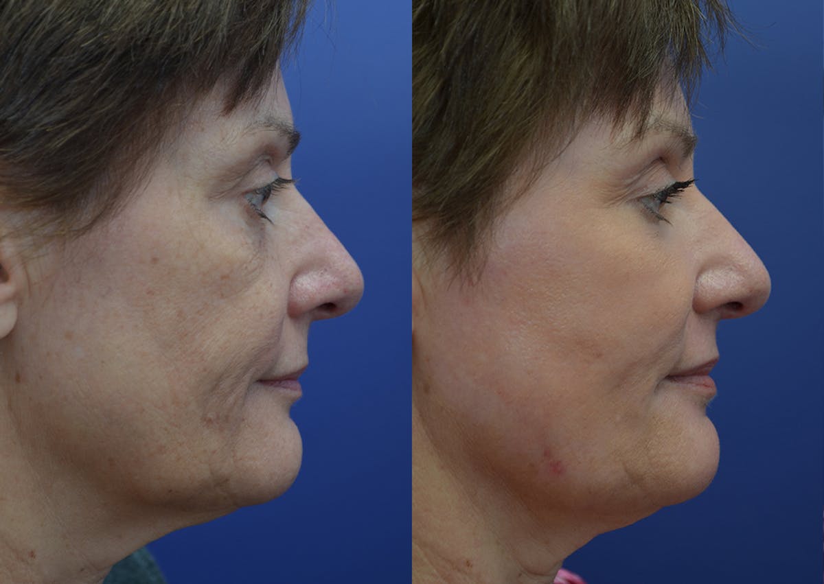 Non-Surgical Soft Tissue Fillers Before & After Gallery - Patient 340218 - Image 5