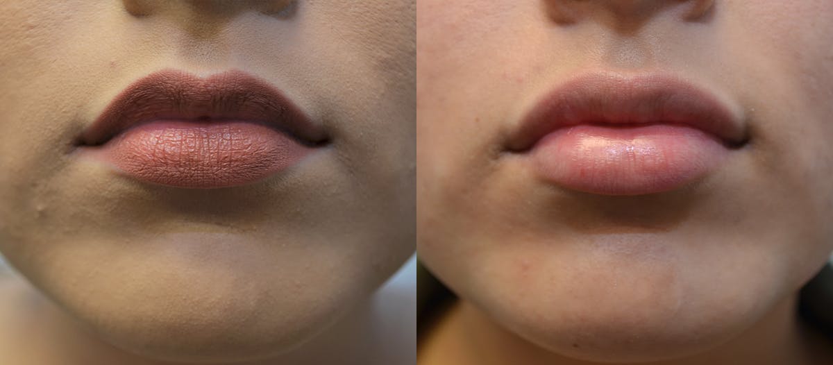 Lip Enhancement Before & After Gallery - Patient 107731 - Image 1