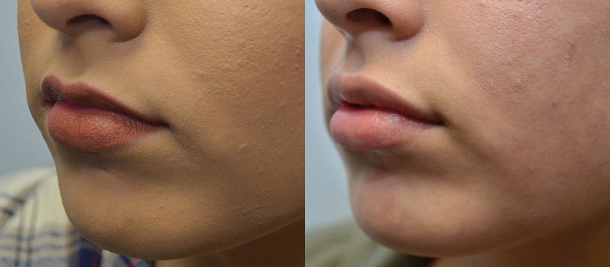 Lip Enhancement Before & After Gallery - Patient 107731 - Image 2