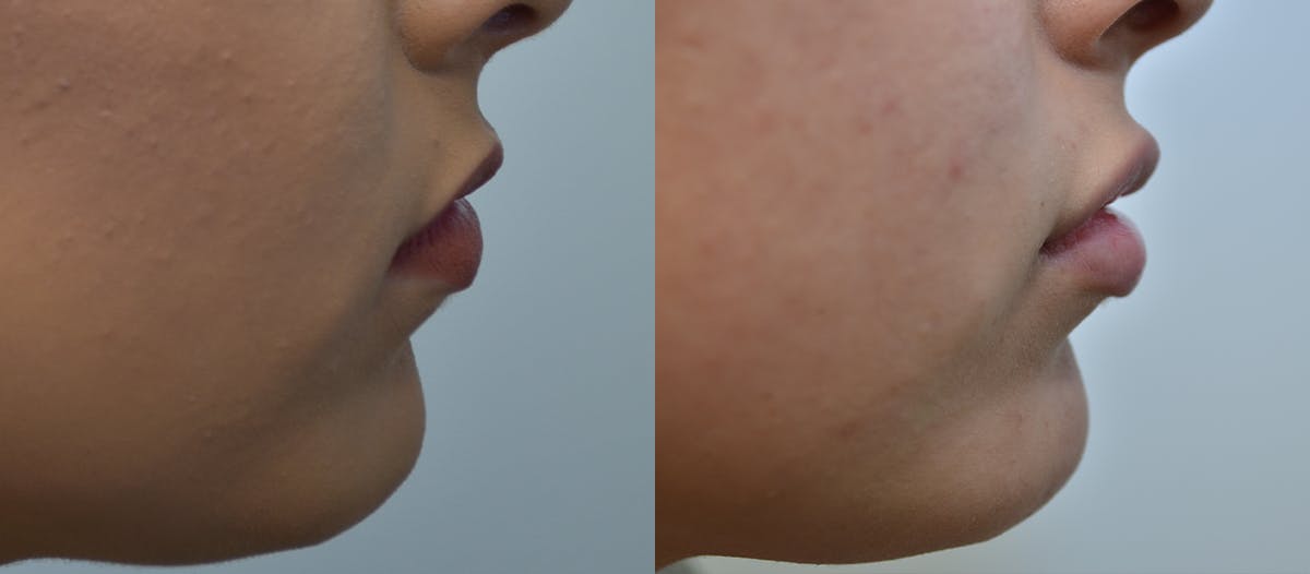 Lip Enhancement Before & After Gallery - Patient 107731 - Image 3