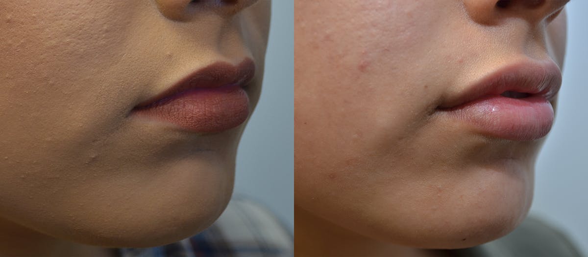 Lip Enhancement Before & After Gallery - Patient 107731 - Image 4