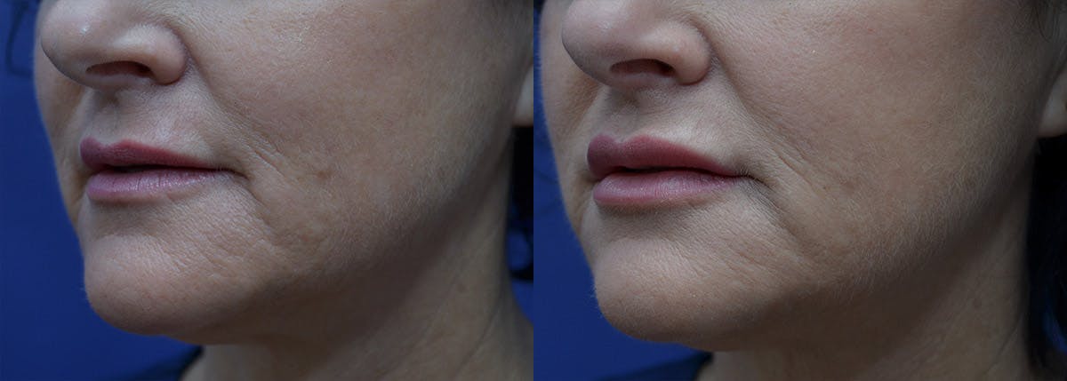 Non-Surgical Soft Tissue Fillers Before & After Gallery - Patient 293611 - Image 2