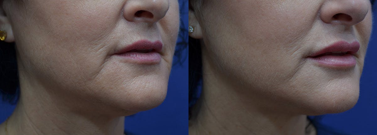 Non-Surgical Soft Tissue Fillers Before & After Gallery - Patient 293611 - Image 3