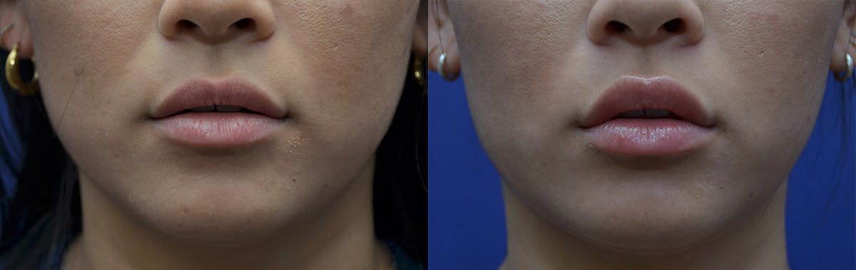 Non-Surgical Soft Tissue Fillers Before & After Gallery - Patient 444129 - Image 1