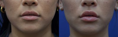 Non-Surgical Soft Tissue Fillers Before & After Gallery - Patient 444129 - Image 1