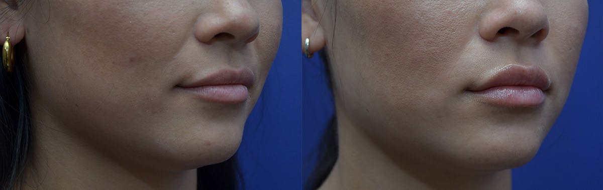 Non-Surgical Soft Tissue Fillers Before & After Gallery - Patient 444129 - Image 2