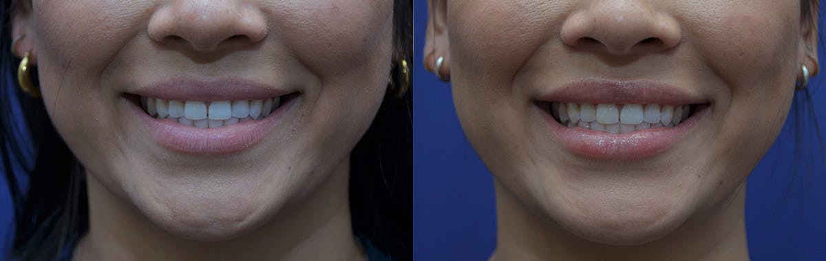 Non-Surgical Soft Tissue Fillers Before & After Gallery - Patient 444129 - Image 3