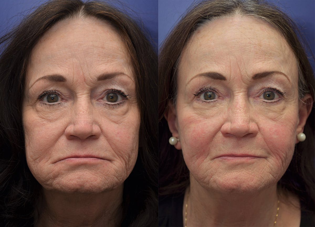 Non-Surgical Soft Tissue Fillers Before & After Gallery - Patient 234513 - Image 1