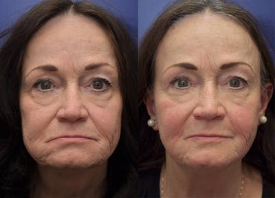 Non-Surgical Soft Tissue Fillers Before & After Gallery - Patient 234513 - Image 1