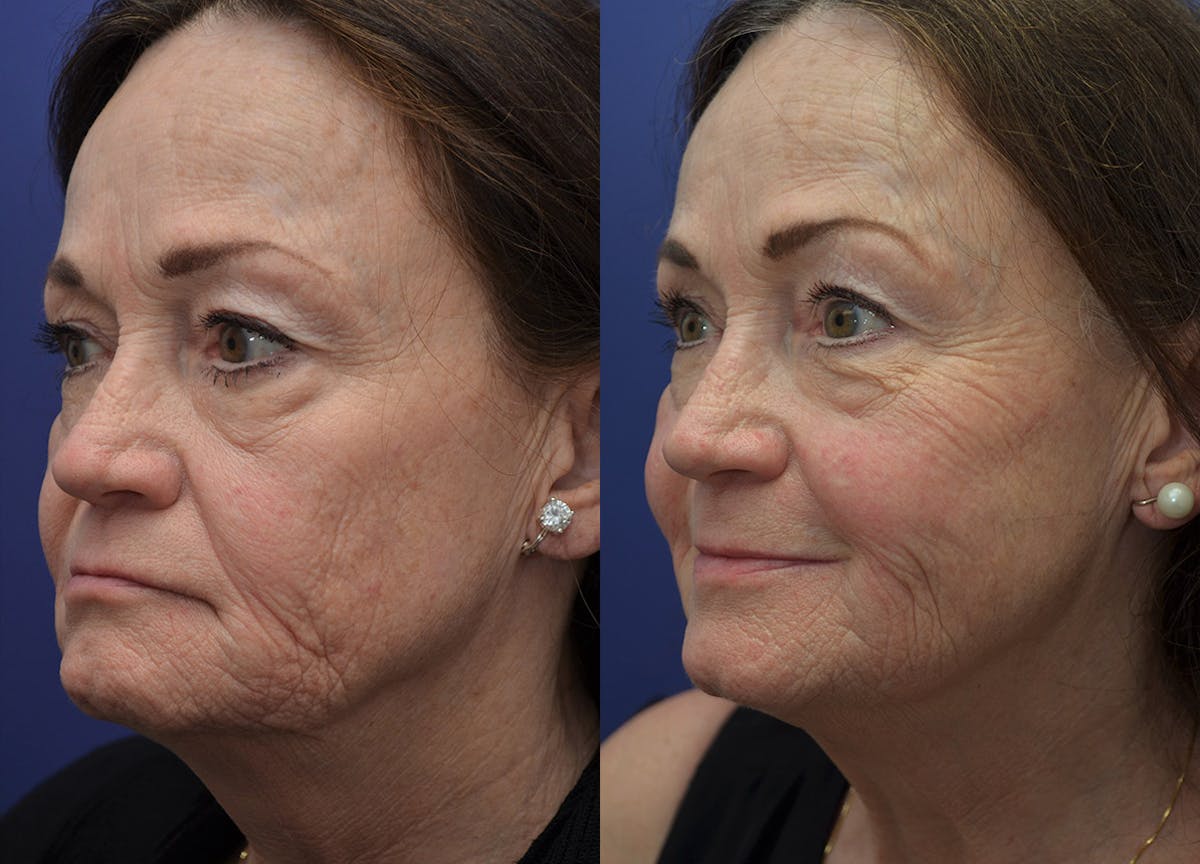 Non-Surgical Soft Tissue Fillers Before & After Gallery - Patient 234513 - Image 2