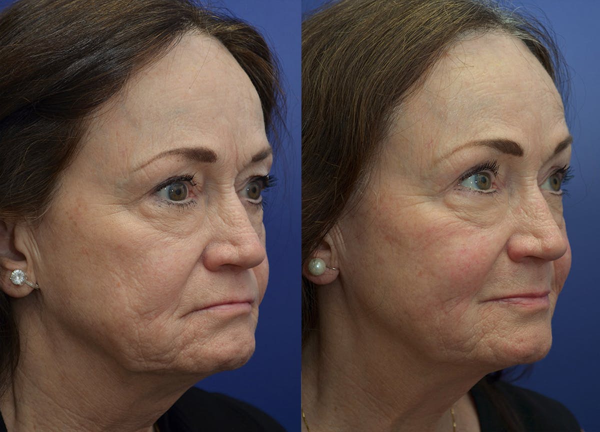 Non-Surgical Soft Tissue Fillers Before & After Gallery - Patient 234513 - Image 3