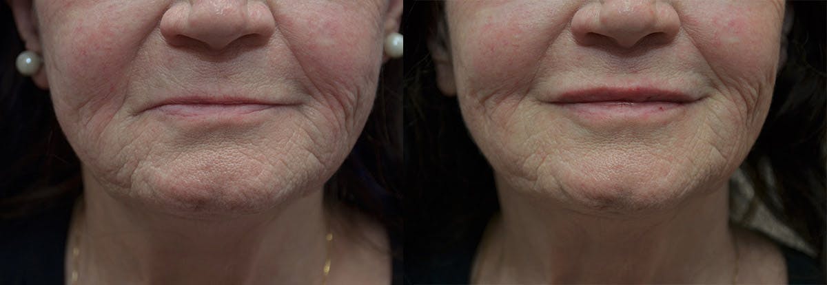 Lip Enhancement Before & After Gallery - Patient 145857 - Image 1