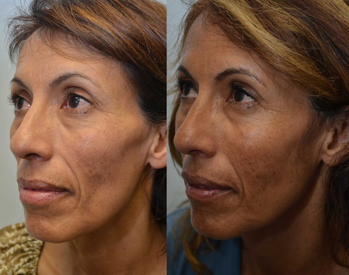 Non-Surgical Soft Tissue Fillers Before & After Gallery - Patient 723769 - Image 2