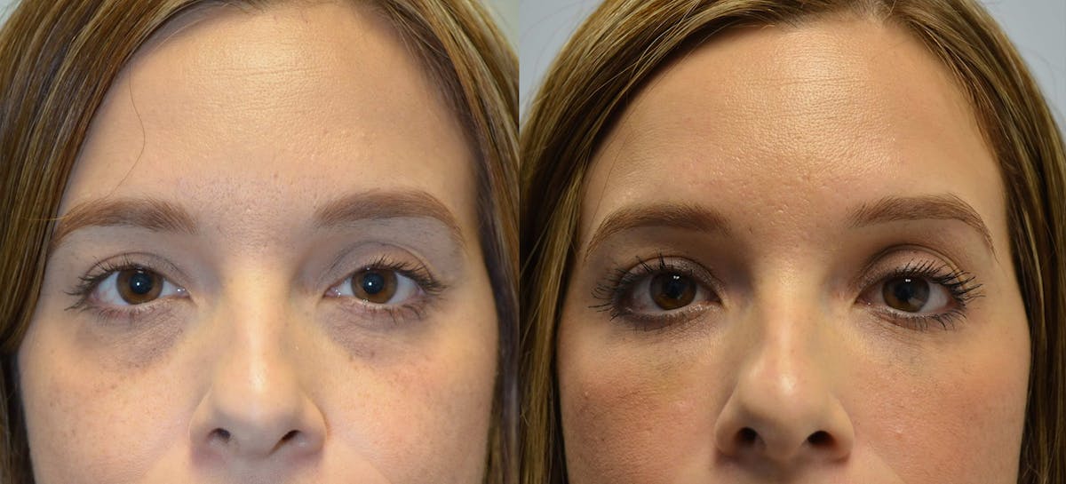Non-Surgical Soft Tissue Fillers Before & After Gallery - Patient 339256 - Image 1
