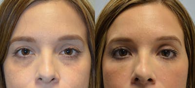 Non-Surgical Soft Tissue Fillers Before & After Gallery - Patient 339256 - Image 1