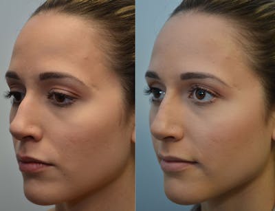 Non-Surgical Soft Tissue Fillers Before & After Gallery - Patient 171920 - Image 1