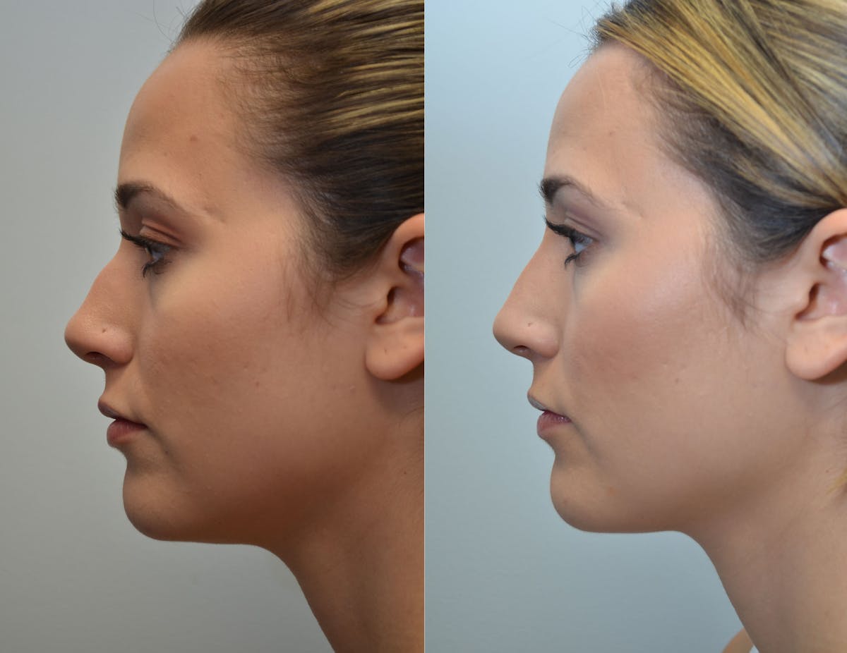 Non-Surgical Soft Tissue Fillers Before & After Gallery - Patient 171920 - Image 2
