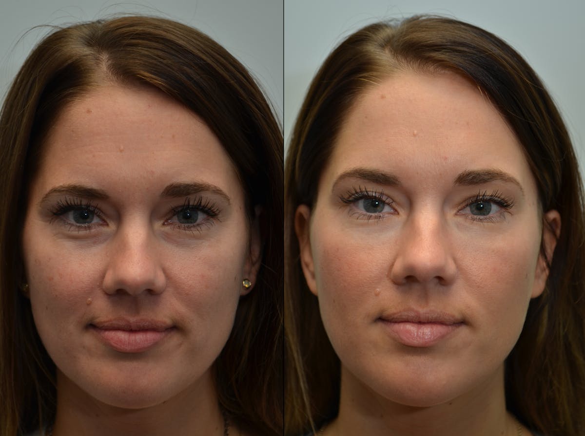 Non-Surgical Soft Tissue Fillers Before & After Gallery - Patient 403600 - Image 2