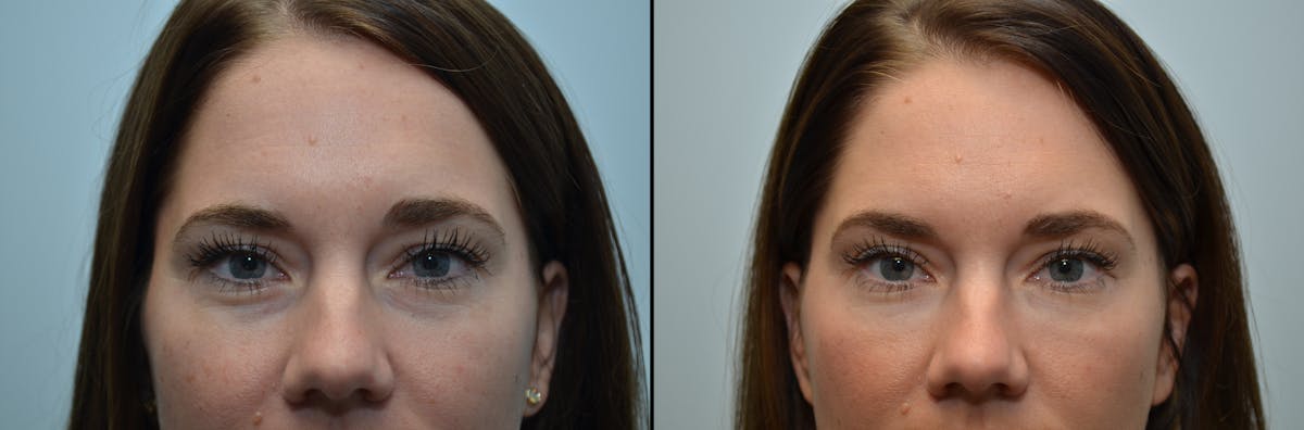 Non-Surgical Soft Tissue Fillers Before & After Gallery - Patient 403600 - Image 3