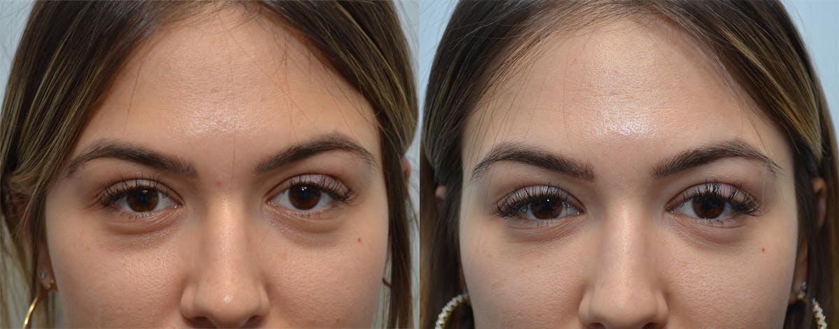 Under Eye Rejuvenation Before & After Gallery - Patient 853826 - Image 1