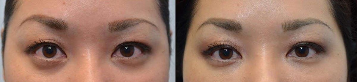 Non-Surgical Soft Tissue Fillers Before & After Gallery - Patient 424370 - Image 1