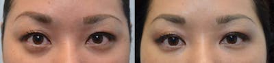 Non-Surgical Soft Tissue Fillers Before & After Gallery - Patient 424370 - Image 1