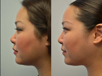 Non-Surgical Soft Tissue Fillers Before & After Gallery - Patient 799702 - Image 1