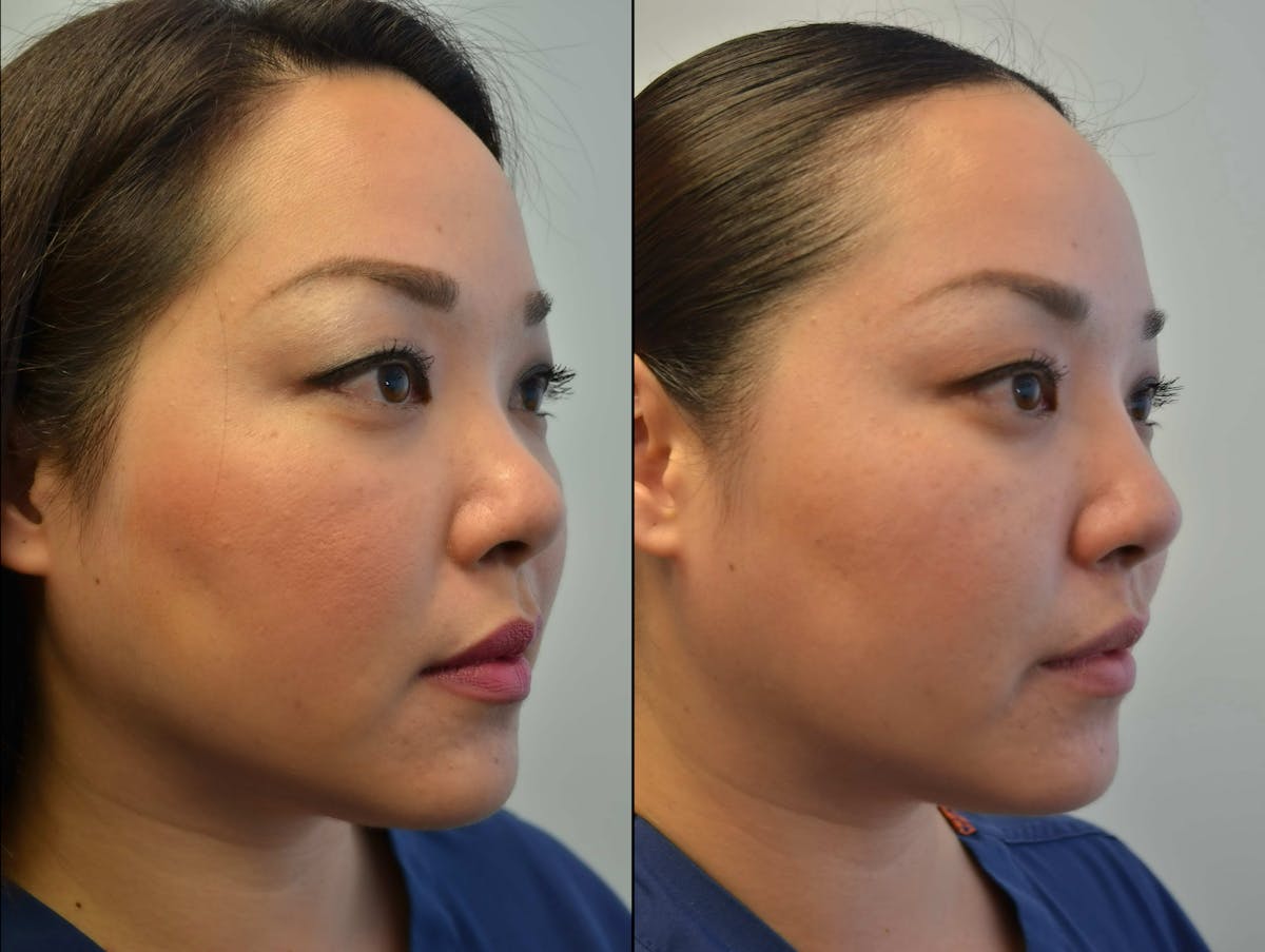 Non-Surgical Soft Tissue Fillers Before & After Gallery - Patient 799702 - Image 2