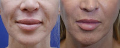 Non-Surgical Soft Tissue Fillers Before & After Gallery - Patient 239357 - Image 1