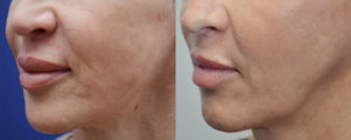 Non-Surgical Soft Tissue Fillers Before & After Gallery - Patient 239357 - Image 2
