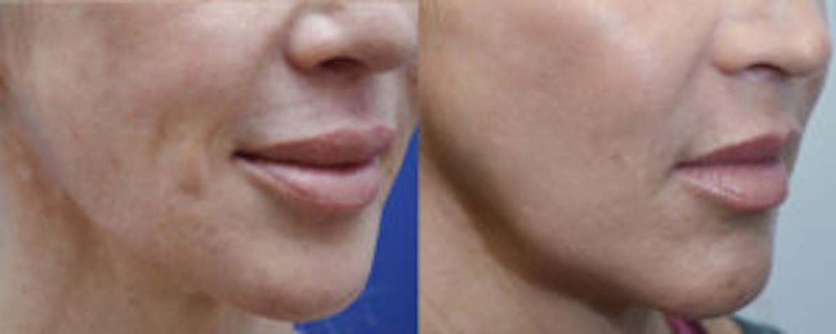 Non-Surgical Soft Tissue Fillers Before & After Gallery - Patient 239357 - Image 3