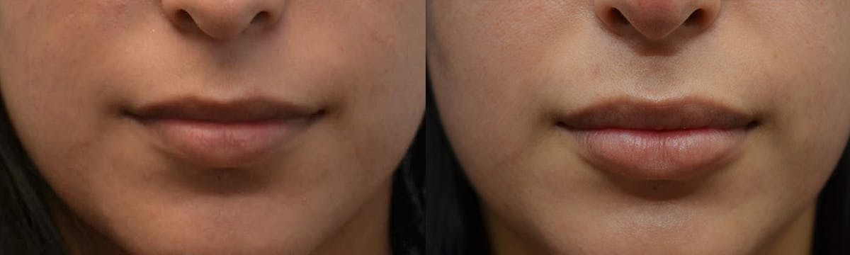 Lip Enhancement Before & After Gallery - Patient 558377 - Image 1