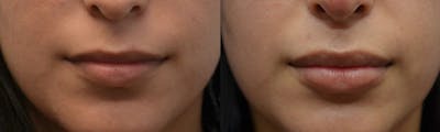 Non-Surgical Soft Tissue Fillers Before & After Gallery - Patient 806562 - Image 1