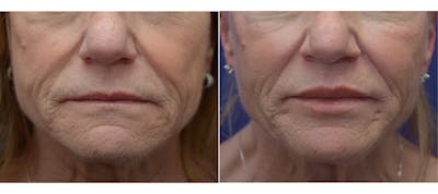 Non-Surgical Soft Tissue Fillers Before & After Gallery - Patient 258685 - Image 1