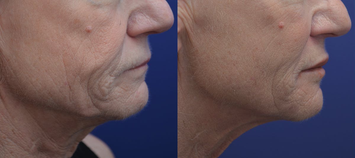 Non-Surgical Soft Tissue Fillers Before & After Gallery - Patient 258685 - Image 2
