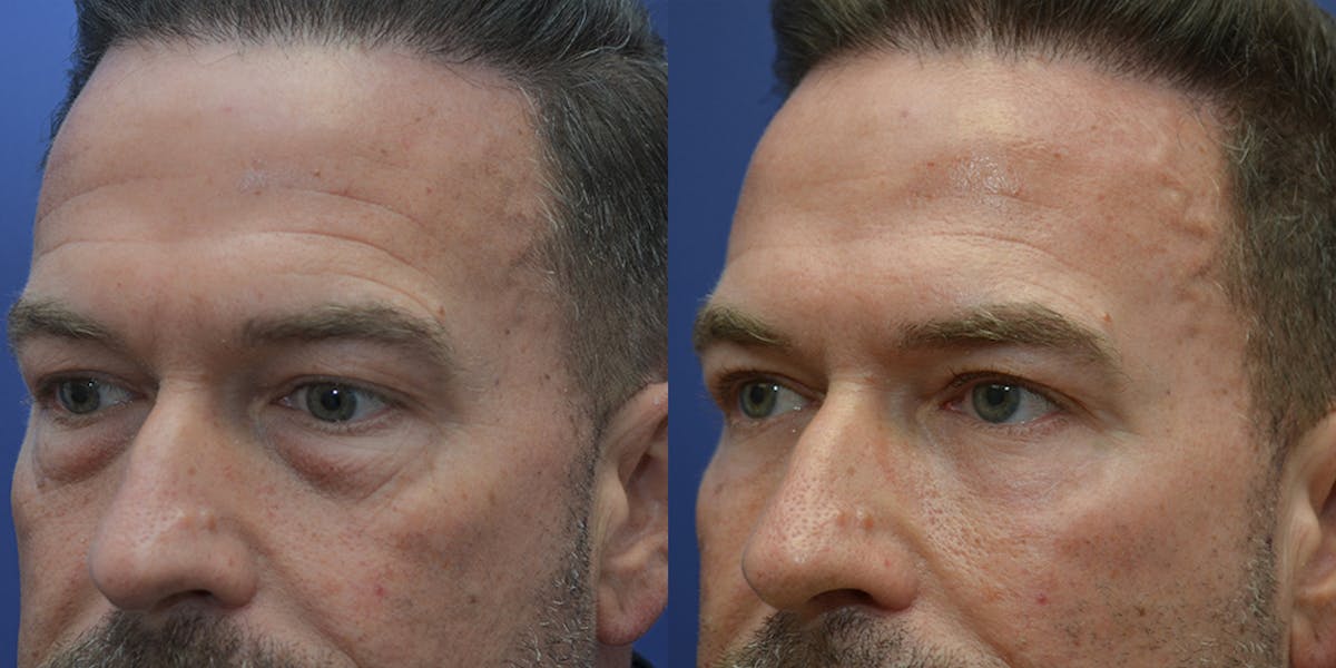 Eyelid Surgery Before & After Gallery - Patient 202647 - Image 2