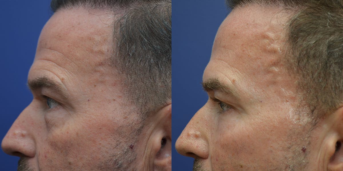 Eyelid Surgery Before & After Gallery - Patient 202647 - Image 3