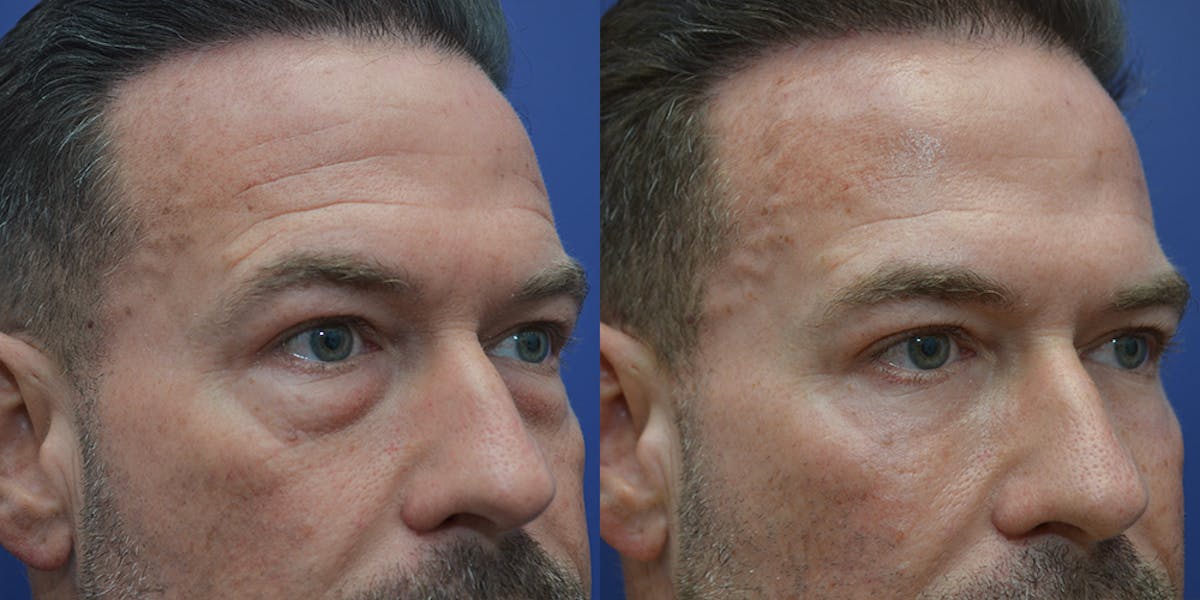 Eyelid Surgery Before & After Gallery - Patient 202647 - Image 4