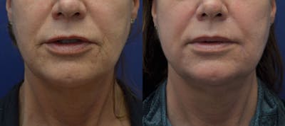 Dermabrasion / Chemical Peel Before & After Gallery - Patient 856418 - Image 1