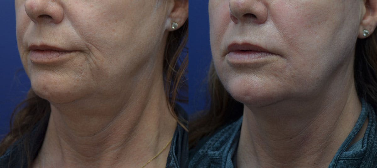 Dermabrasion / Chemical Peel Before & After Gallery - Patient 856418 - Image 2