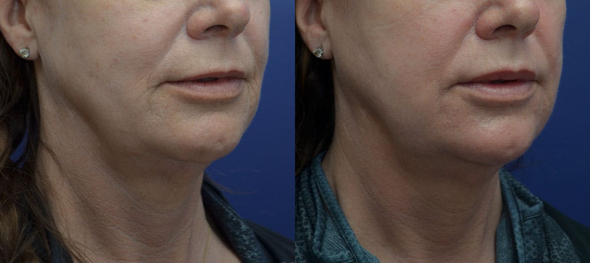 Dermabrasion / Chemical Peel Before & After Gallery - Patient 856418 - Image 3