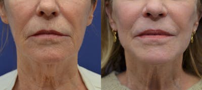 Dermabrasion / Chemical Peel Before & After Gallery - Patient 370829 - Image 1