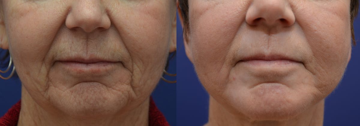 Dermabrasion / Chemical Peel Before & After Gallery - Patient 402856 - Image 1