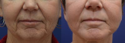 Dermabrasion / Chemical Peel Before & After Gallery - Patient 402856 - Image 1