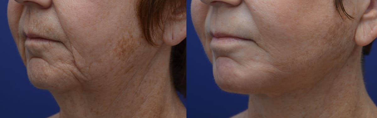 Dermabrasion / Chemical Peel Before & After Gallery - Patient 402856 - Image 2