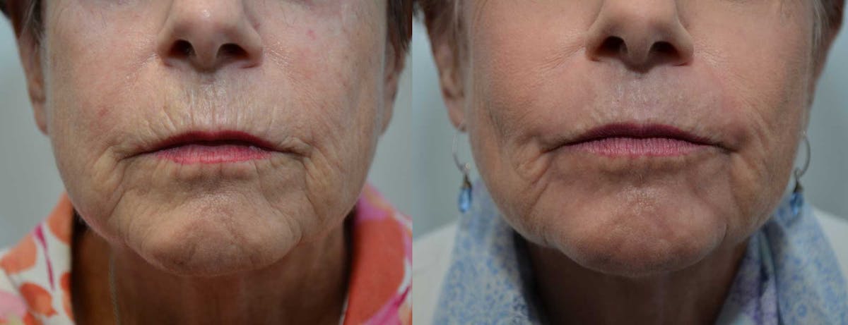 Dermabrasion / Chemical Peel Before & After Gallery - Patient 483241 - Image 1