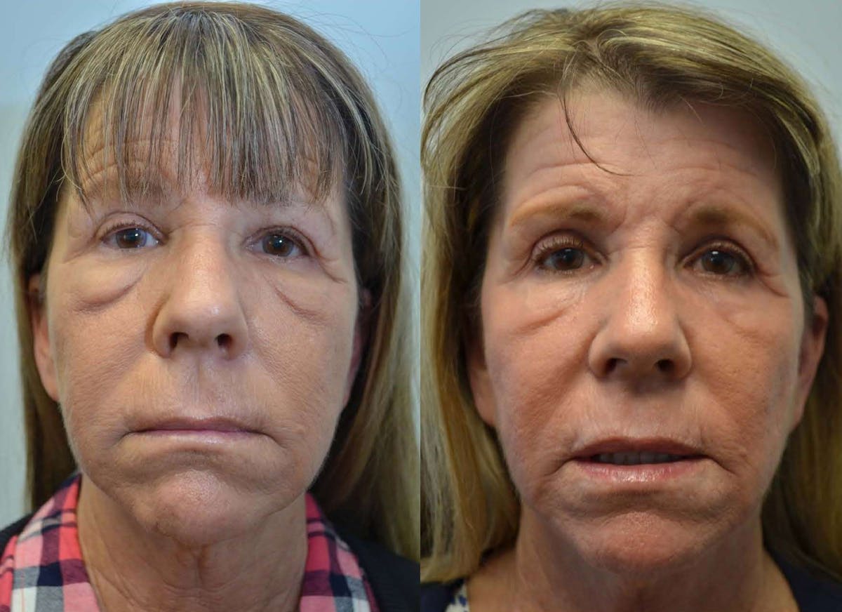 CO2 Laser Resurfacing Before & After Gallery - Patient 181955 - Image 1