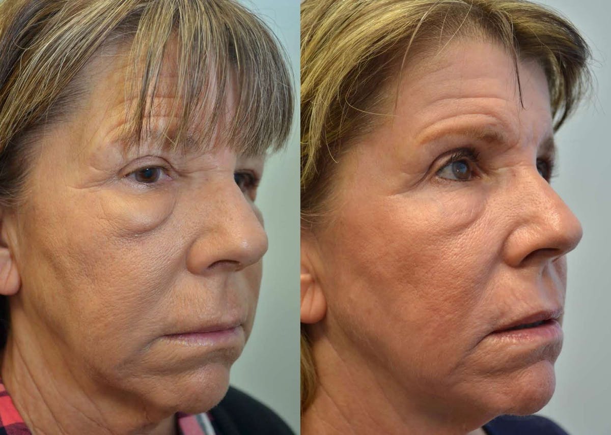 CO2 Laser Resurfacing Before & After Gallery - Patient 181955 - Image 2