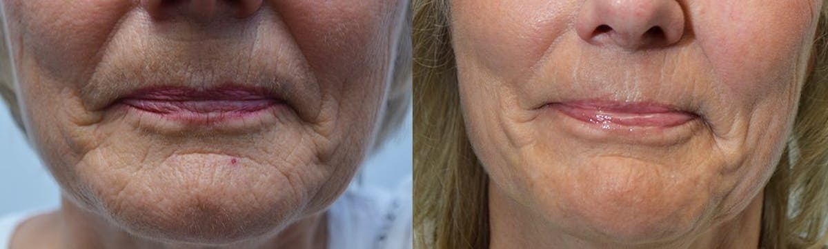 CO2 Laser Resurfacing Before & After Gallery - Patient 411090 - Image 1